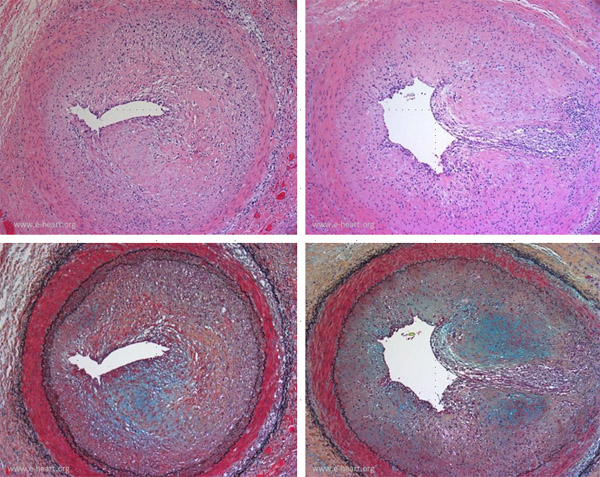 CAV coronary arteries LM & Movat